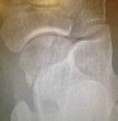 Talar Head Fracture